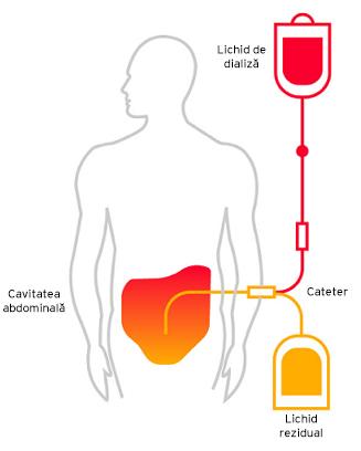 Peritoneal dialysis _image_RO