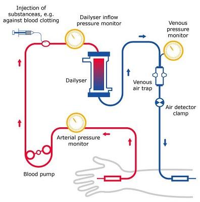 frequent haemodialysis in detail